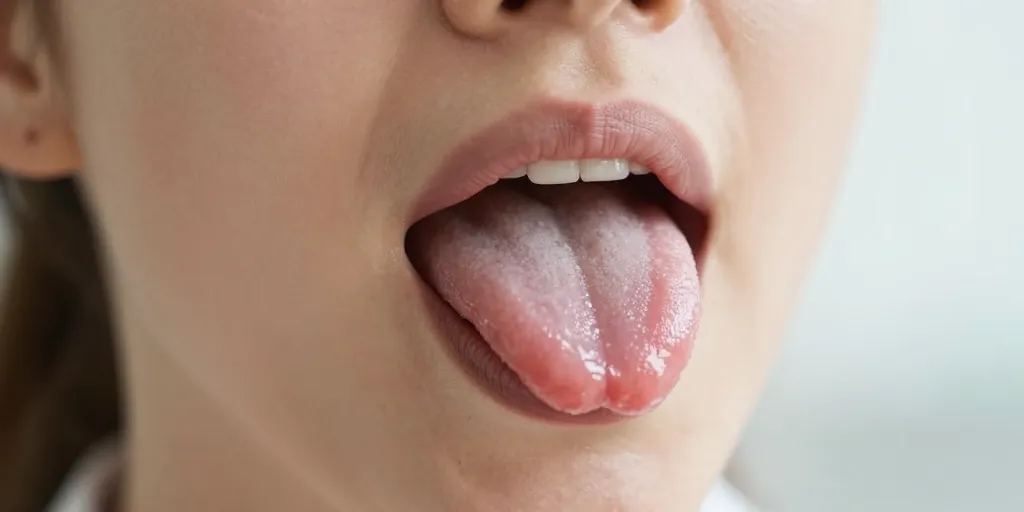 langue dentelée thyroïde