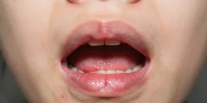 inflammation de la bouche et de la langue